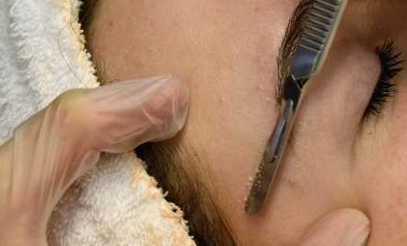 esthetician doing microdermabrasion
